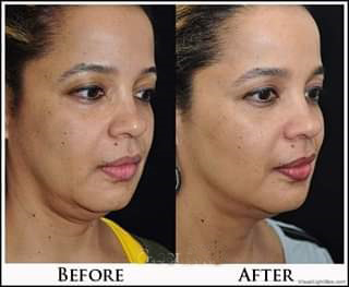 Skin Tightening